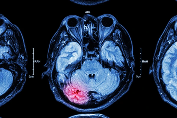 Brain Injuries